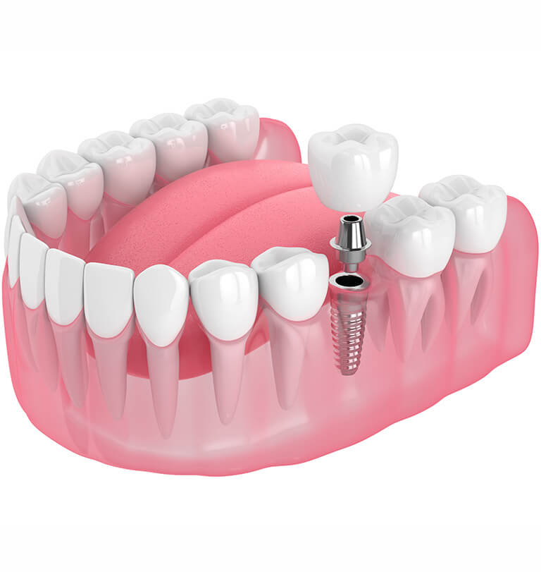 インプラント治療