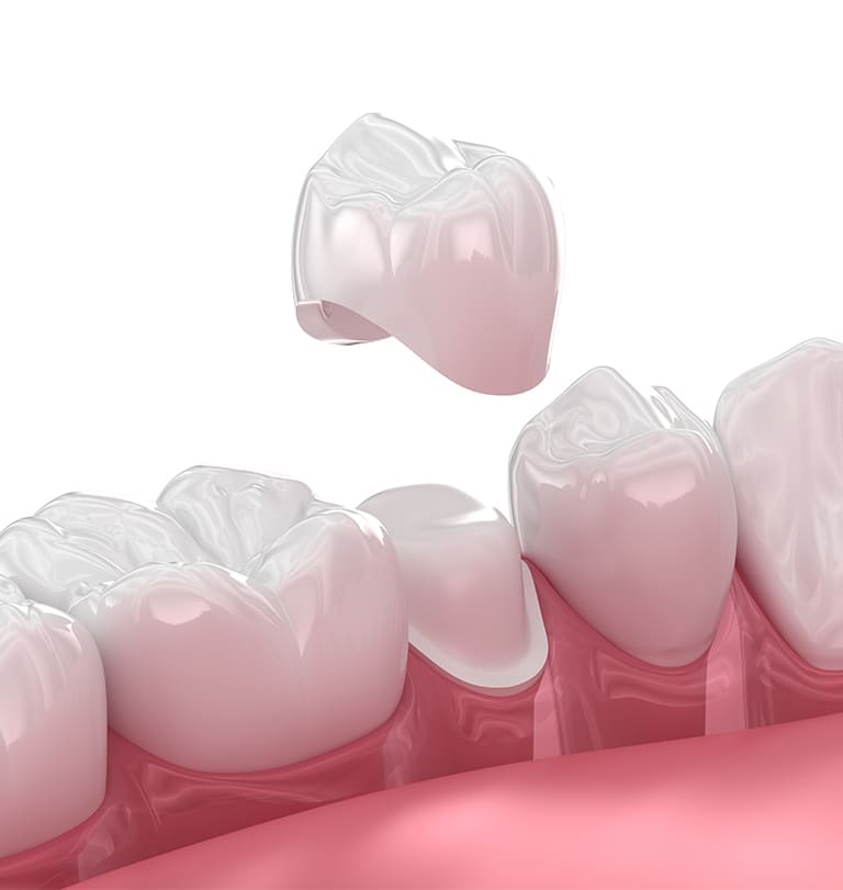 審美的セラミック治療